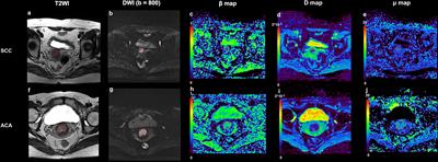 Cervical Carcinoma: Evaluation Using Diffusion MRI With a Fractional Order Calculus Model and its Correlation With Histopathologic Findings